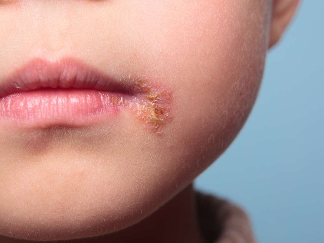 Cuando el Herpes es reincidente 